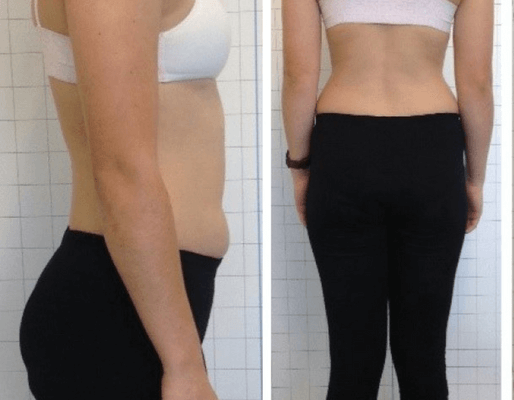 Correction of a moderate thoracolumbar scoliosis using a ScoliNight orthosis and Scoliosis Specific Rehabilitation