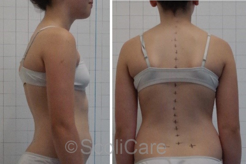 Lateral postural photographs (Left), Posteroanterior postural photograph (Right).