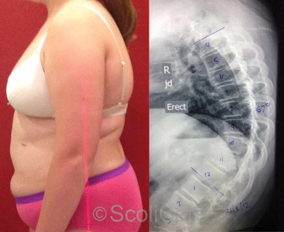Lateral postural photograph (Left). Lateral x-ray indicating a hyper-kyphosis (Right)