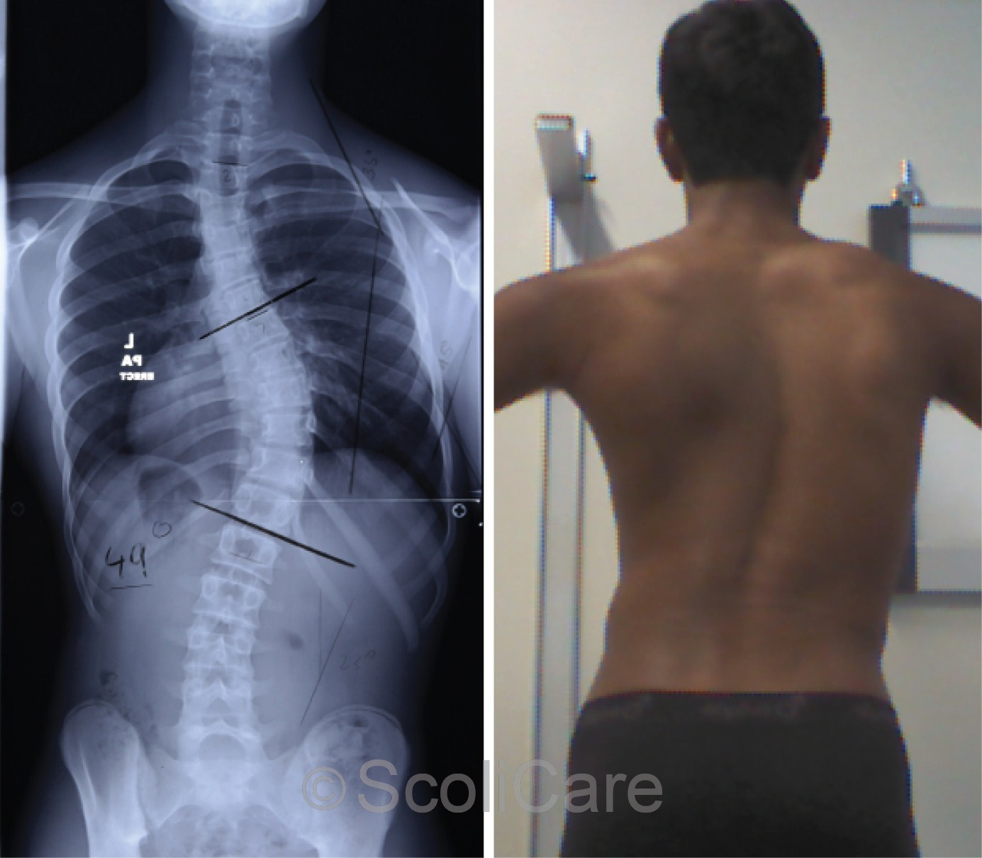 Standing posteroanterior x-ray demonstrating a 49° right thoracic scoliosis (Left), Standing posteroanterior postural photograph (Right).