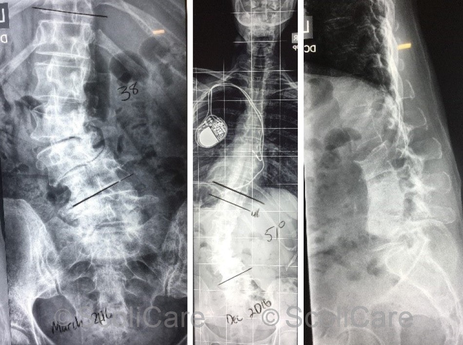 Posteroanterior spine x-ray highlighting a 38° (Cobb) left lumbar scoliosis taken 10 months prior to the initial consultation (Left)