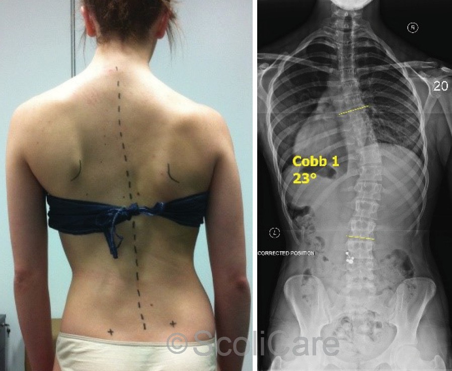 Posteroanterior photograph with the patient performing an active self-correction (Left)