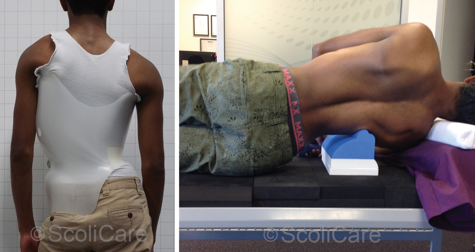 Posteroanterior postural photograph of the patient wearing the ScoliBrace orthosis (Left), Side-lying photograph of the patient on the ScoliRoll (Right)