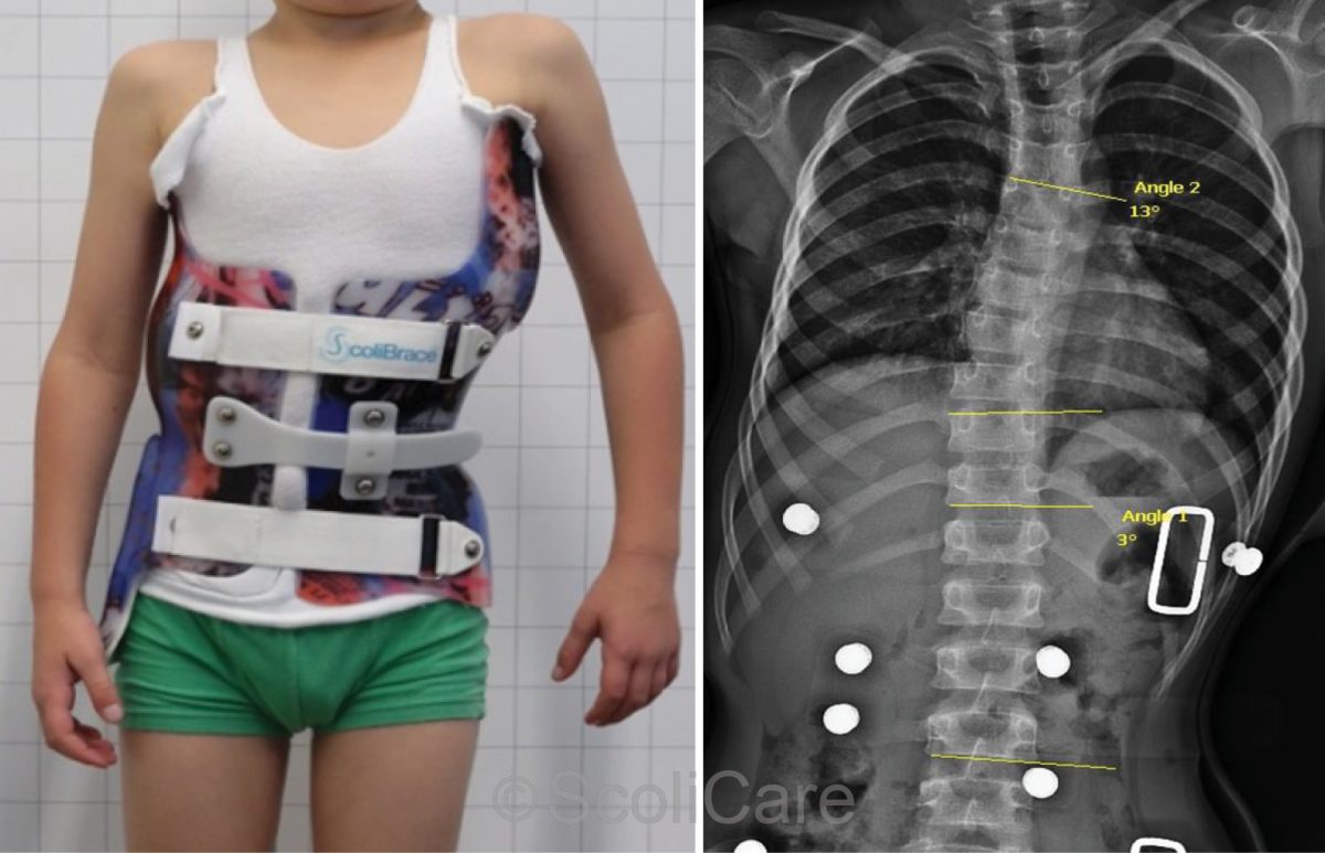 Superior in-brace correction achieved with a ScoliBrace