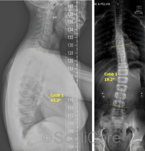 Lateral x-ray with a kyphosis angle measuring 42° (Left), Posteroanterior full spine x-ray demonstrating a 19° thoracolumbar scoliosis (Right)