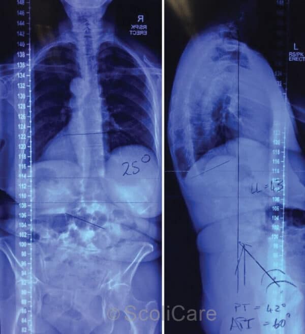 Posteroanterior full-spine x-ray highlighting a 25° (Cobb) right lumbar scoliosis (Left), Lateral full-spine x-ray (Right).