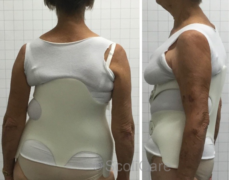 reduced pain in an elderly female patient with adult spinal deformity