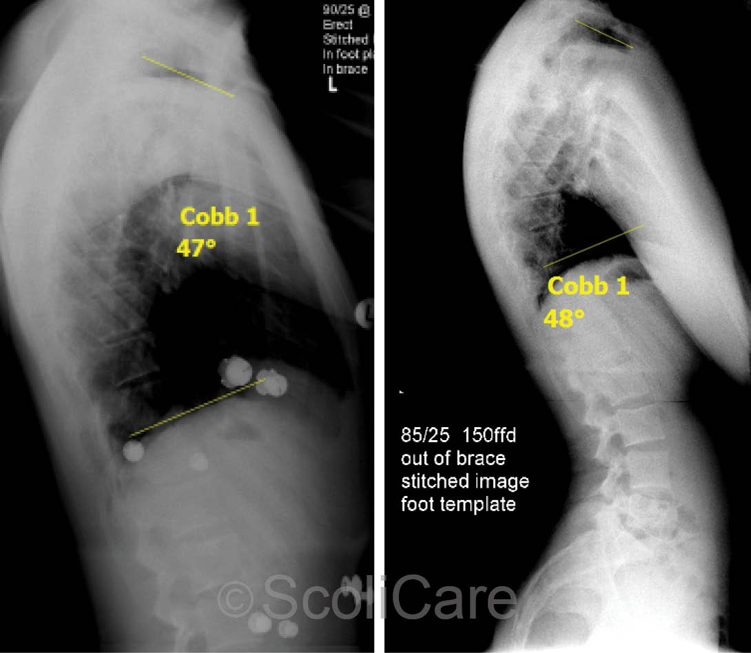 Three-month lateral in-brace x-ray highlighting a 47° kyphosis (Left), Four-month lateral out-of-brace x-rays demonstrating a 48° kyphosis (Right).