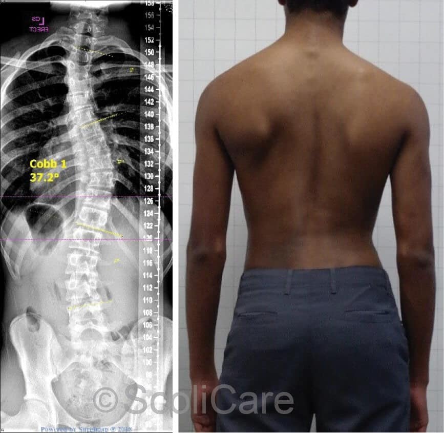 Standing posteroanterior x-ray indicating a right 37° thoracic scoliosis (Left), Posteroanterior postural photograph (Right)