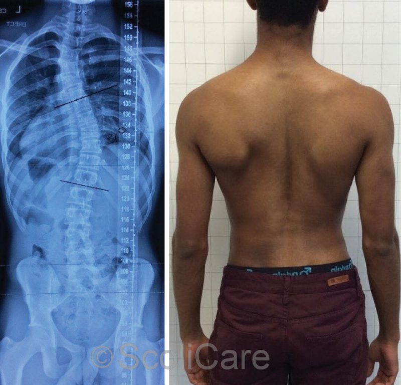 Reduction of severe scoliosis in a 14-year-old male patient