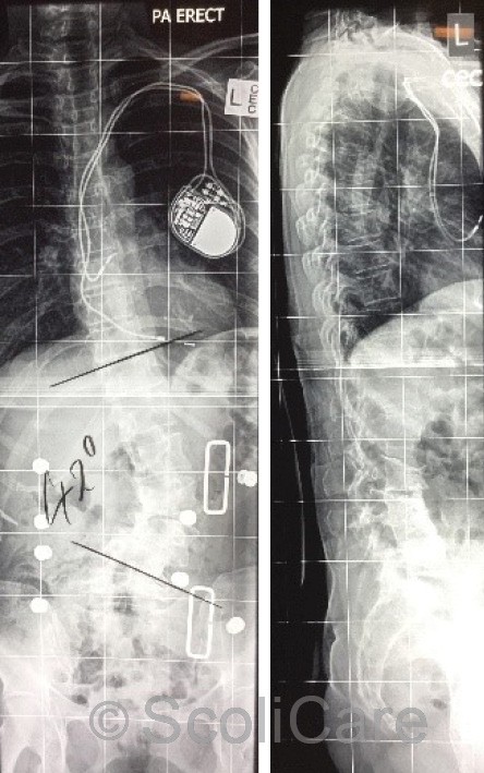 Posteroanterior in-brace x-ray with a 42° left lumbar scoliosis