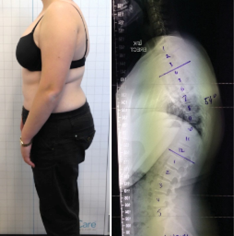 Lateral postural photograph (Left). Lateral x-ray indicating 54° thoracic kyphosis (Right)
