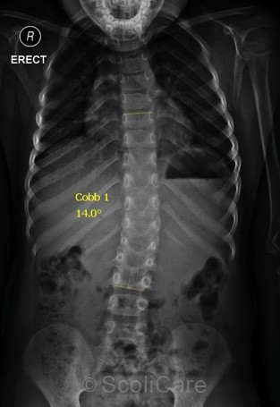 Posteroanterior x-ray