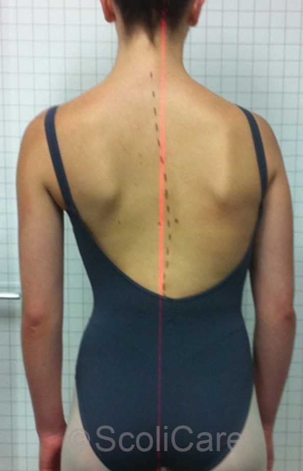  Posteroanterior postural photograph taken after six months of treatment.