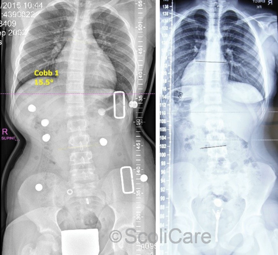 Supine anteroposterior x-ray highlighting that the patient’s scoliosis was over-corrected to 16° in-brace after 1 month