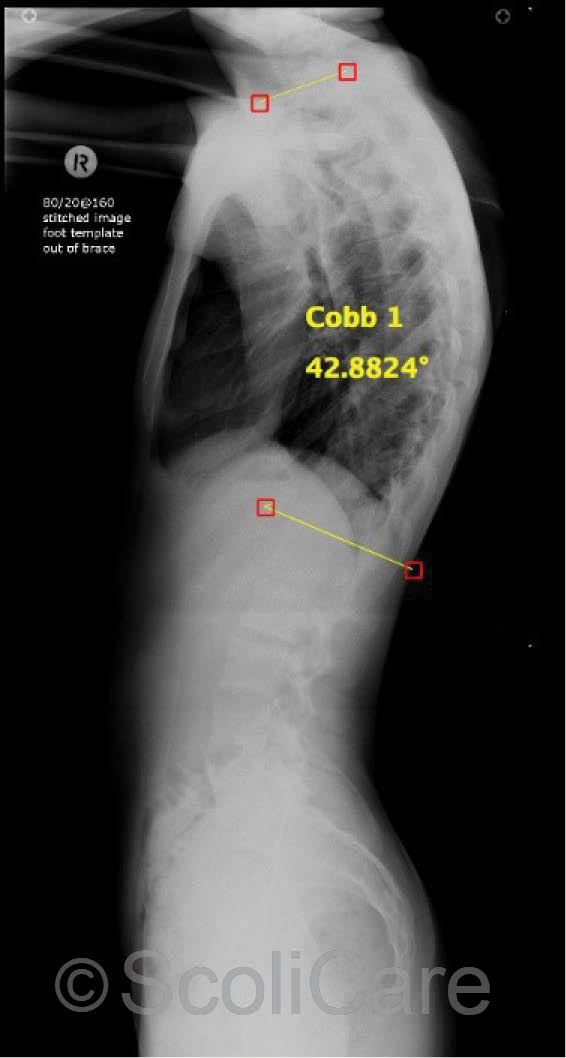 Plain film lateral x-rays taken 6 months after the cessation of brace wear. The kyphosis measured 43° at this time.