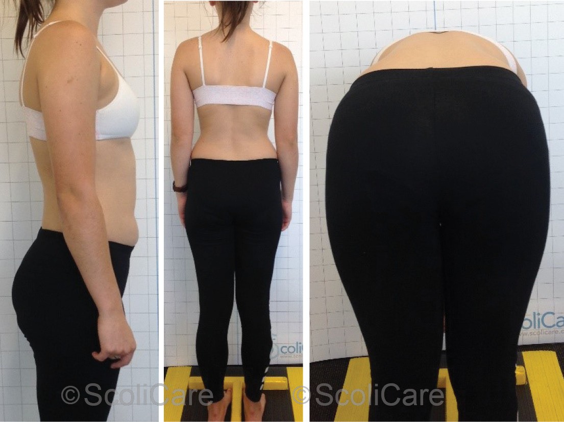 Lateral postural photograph (Left), Posteroanterior photograph (Middle), Adam’s forward bend test (Right).