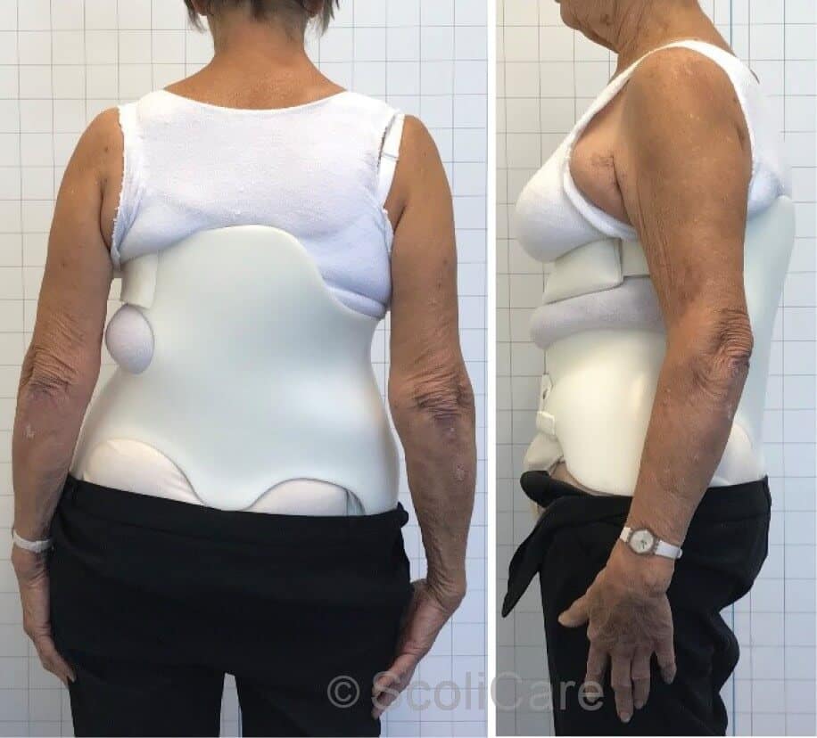 Posteroanterior postural photograph in-brace (Left), Lateral postural photograph in-brace (Right)