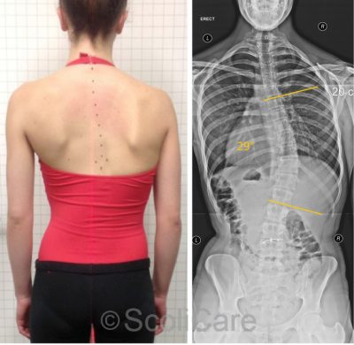 ScoliBrace | Scoliosis Center of Utah | Salt Lake City's Scoliosis ...