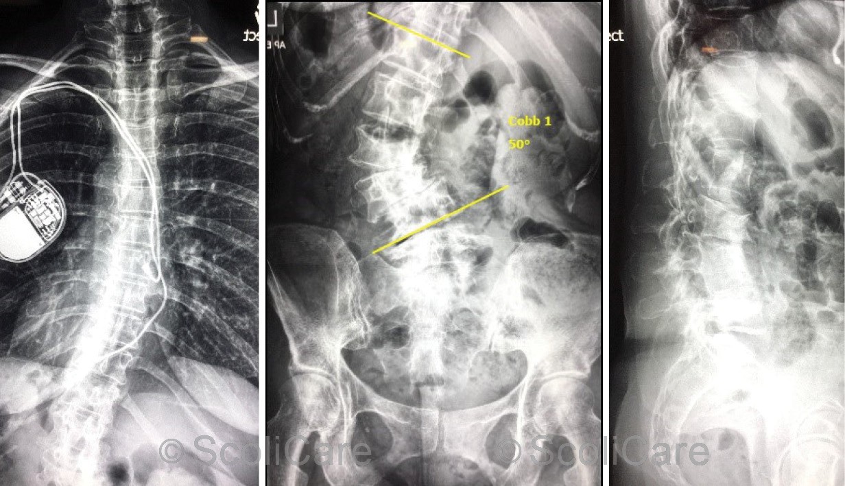 Posteroanterior thoracic spine x-ray out-of-brace (Left), posteroanterior lumbopelvic x-ray out-of-brace highlighting a 50° left lumbar scoliosis (Middle) Lateral lumbar