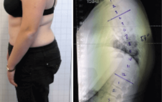 Reduction of a Hyper-kyphosis in a 16-year-old female patient using a KyphoBrace