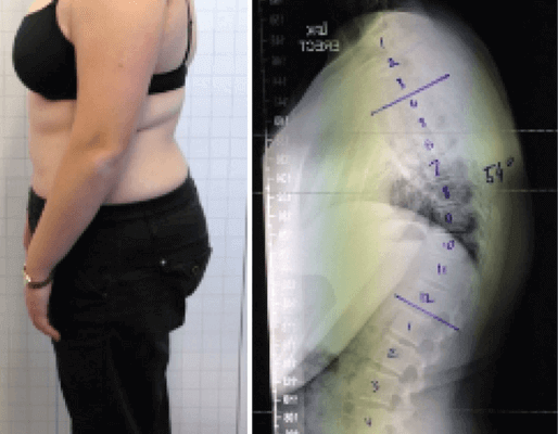 Reduction of a Hyper-kyphosis in a 16-year-old female patient using a KyphoBrace