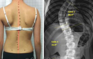 Reduction of a severe scoliosis using ScoliBrace in a Young Female Gymnast