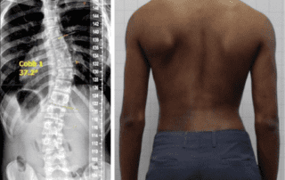 Reduction of a severe scoliosis using a ScoliBrace and scoliosis specific rehabilitation in a 14-year-old male