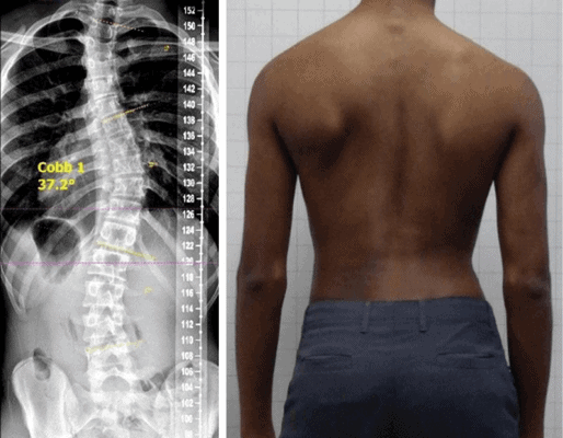 Reduction of a severe scoliosis using a ScoliBrace and scoliosis specific rehabilitation in a 14-year-old male