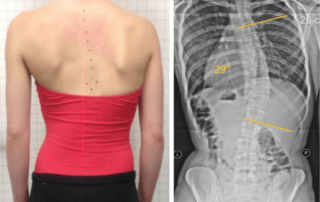 Resolution of a Juvenile Idiopathic Scoliosis (JIS) using a Low-Profile ScoliBrace and Scoliosis Specific Rehabilitation