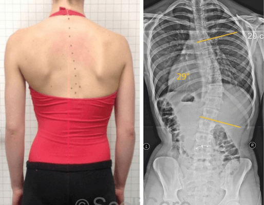 Resolution of a Juvenile Idiopathic Scoliosis (JIS) using a Low-Profile ScoliBrace and Scoliosis Specific Rehabilitation