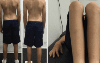 Resolution of a Juvenile Idiopathic Scoliosis (JIS) using a Low-Profile ScoliBrace and Scoliosis Specific Rehabilitation