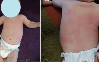 Resolution of a moderate scoliosis in an infant patient using a ScoliBrace