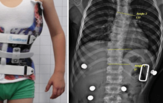 Superior in-brace correction achieved with a ScoliBrace