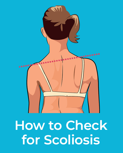 How to Check for Scoliosis