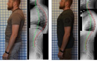 hyper-kyphosis before and after