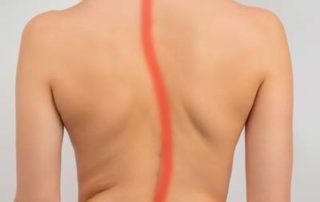 10 Signs You May Have Undiagnosed Scoliosis