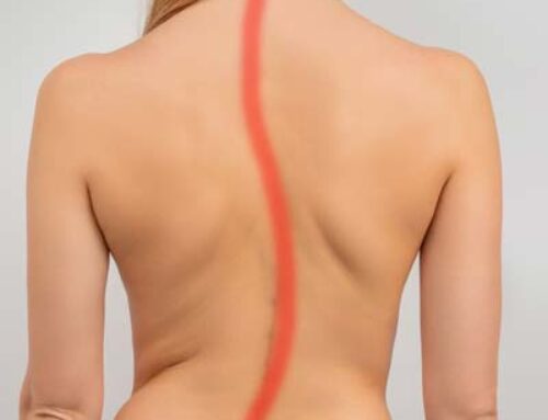 10 Signs You May Have Undiagnosed Scoliosis