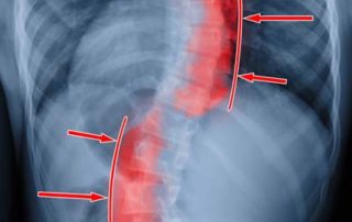 Does Scoliosis Always Require Surgery