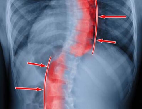 Does Scoliosis Always Require Surgery?