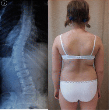 Scoliosis 12 Years