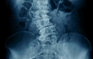 If I Have Bad Posture, Does That Mean I Have Scoliosis? PART 2