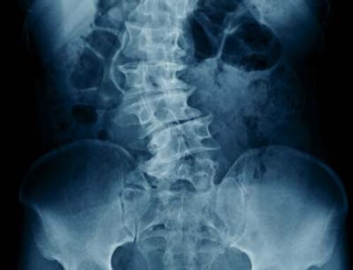 If I Have Bad Posture, Does That Mean I Have Scoliosis? P2