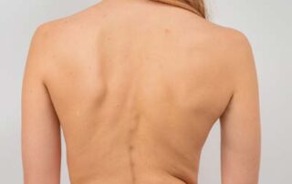 The Many Symptoms of Scoliosis: Beyond Back Pain and Spinal Curves