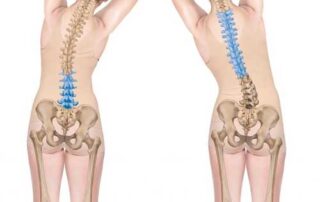 Can Scoliosis Cause More Stress in Your Life? Scoliosis Treatment in Midvale, Utah