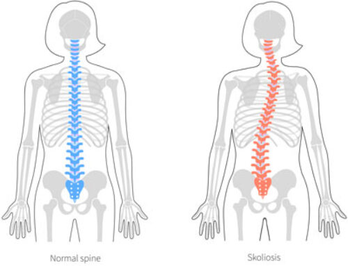 Chiropractic Care for Scoliosis and Posture Correction